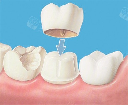常见的有美容冠修复,瓷贴面美容修复,口腔正畸矫正,牙齿美白这几类