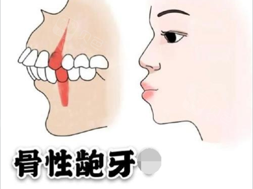 骨性龅牙可以矫正回来吗包头哪家牙科能做骨性龅牙矫治
