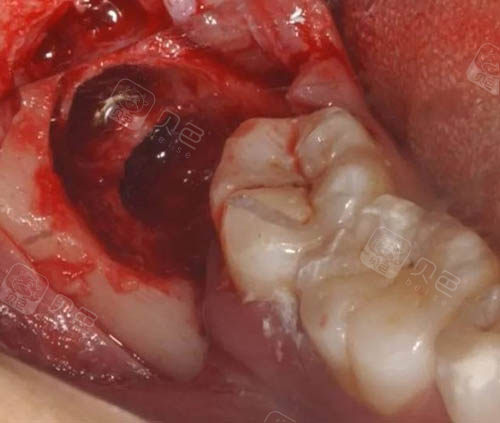 5位牙友拔牙经历告诉你柳州拔智齿多少钱以及拔牙哪家好