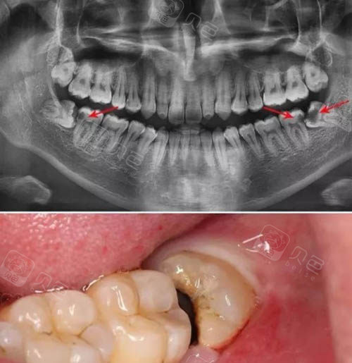 5位牙友拔牙经历告诉你柳州拔智齿多少钱以及拔牙哪家好