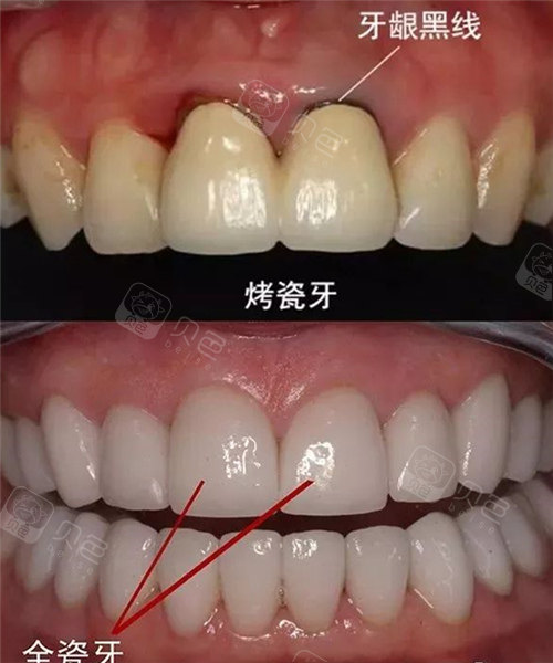 牙冠多少钱一颗2021价格表树脂烤瓷全瓷价格都全面
