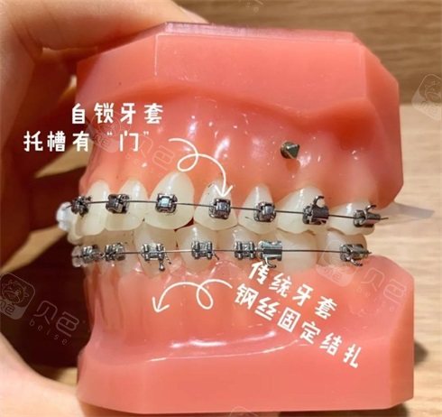 银川艾齿口腔医院牙齿矫正器示意图