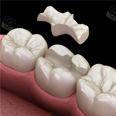 广州牙齿修复多少钱一颗不同方式修复价格千差万别