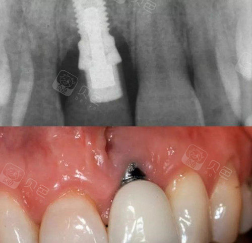 牙槽骨吸收种植牙牙根裸露