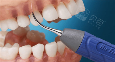 3位牙友分享广州龈下刮治费用以及你关心的报销