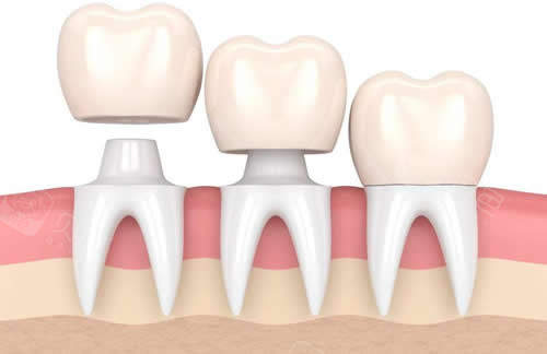 佩戴牙冠修复卡通示意图