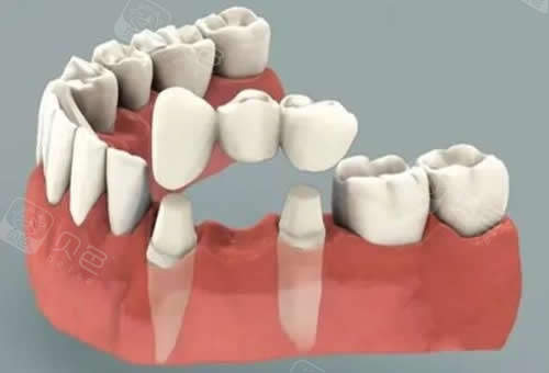 牙冠修复卡通介绍图