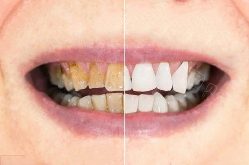 牙齿贴面前后对比