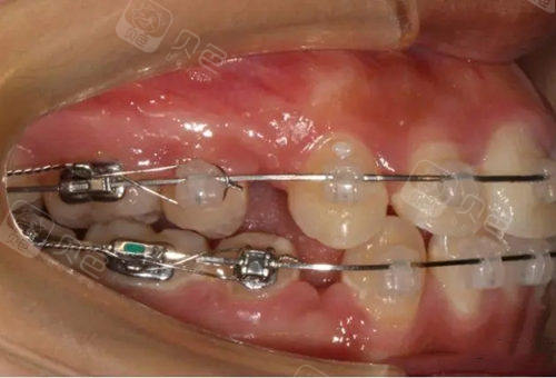 牙齿矫正钢丝收缝和橡皮筋收缝的区别都有哪些哪个更好