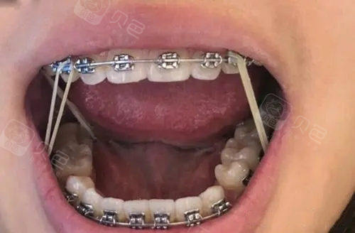 牙齿矫正钢丝收缝和橡皮筋收缝的区别都有哪些哪个更好