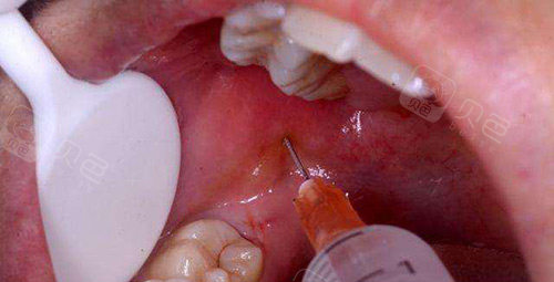 牙科怎么治疗牙齿松动怎么办？重庆牙科医院牙齿松动的治疗方法有哪些_https://www.jmylbn.com_新闻资讯_第1张