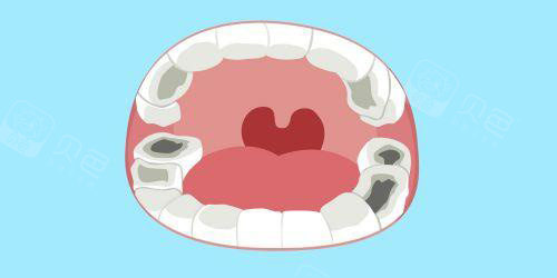 牙科怎么治疗牙齿松动怎么办？重庆牙科医院牙齿松动的治疗方法有哪些_https://www.jmylbn.com_新闻资讯_第2张