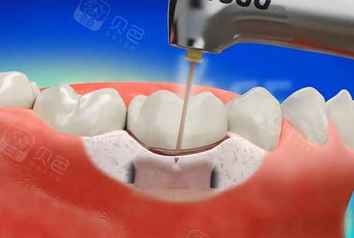 牙科怎么治疗牙齿松动怎么办？重庆牙科医院牙齿松动的治疗方法有哪些_https://www.jmylbn.com_新闻资讯_第3张