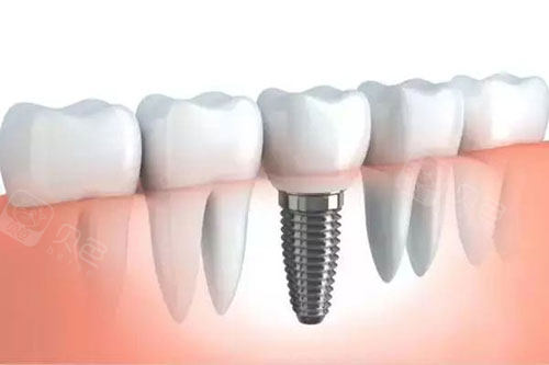 牙科怎么治疗牙齿松动怎么办？重庆牙科医院牙齿松动的治疗方法有哪些_https://www.jmylbn.com_新闻资讯_第6张