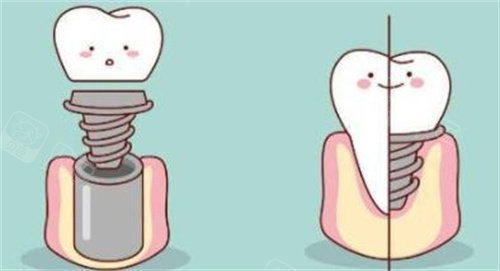 这两家奉贤牙科种牙技术高超堪比奉贤牙防所种植牙水平