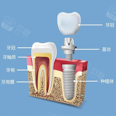 通州区老年种牙有哪些医院揭秘北京通州哪里种植牙比较好