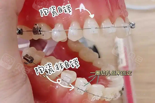 陶瓷自锁和非自锁矫正图