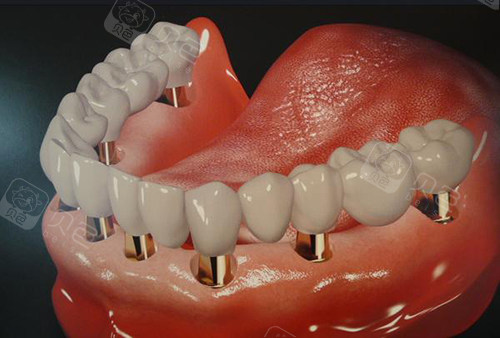 石家庄全口假牙大概需要多少费用镶牙种牙价格全都有