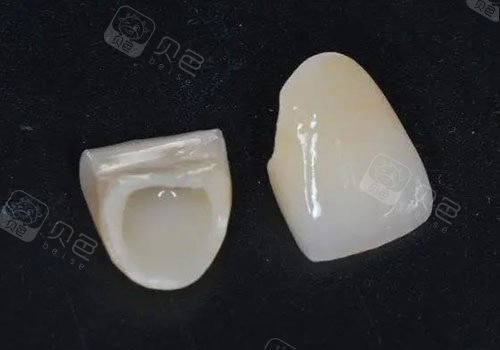 抚顺全瓷牙多少钱一颗分享当地全瓷牙详细价格参考