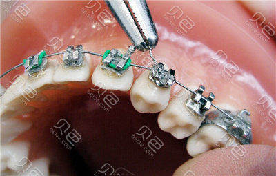 学生牙齿矫正一般选择哪种矫正器金属陶瓷还是隐形