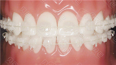 半隐形托槽矫正器