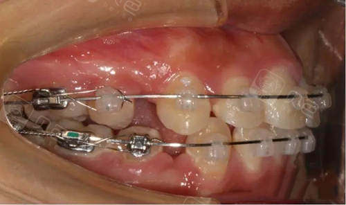 牙齿正畸拔牙四个收缝要多久亲身经历告诉你正畸收缝时间