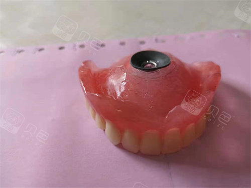 杨浦区装活动假牙哪家医院好大爷大妈都爱来这五家