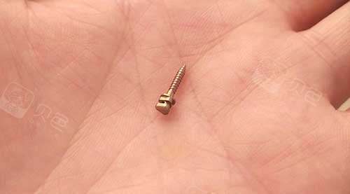 牙齿矫正支抗钉