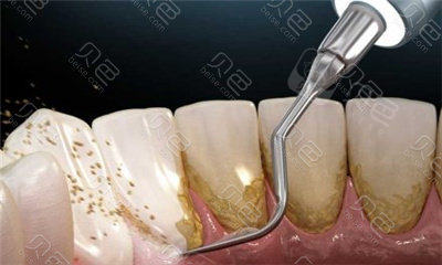 清洗牙齿内侧的牙结石