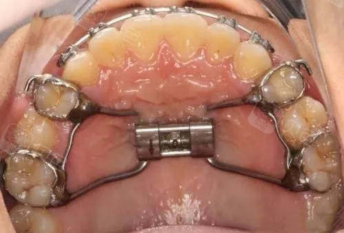 牙齿矫正扩弓好还是拔牙好?哪种方式矫正更快