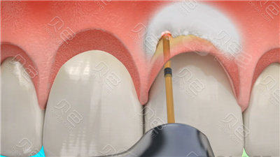 口腔激光怎么治疗水激光牙周治疗有用吗？这种新科技可以做很多口腔治疗!_https://www.jmylbn.com_新闻资讯_第4张