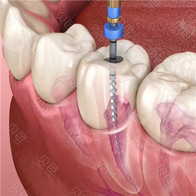 疼几天牙神经自己会死?