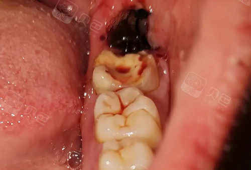 智齿拔掉一年了还是有洞怎么回事而且拔智齿后嘴巴超臭