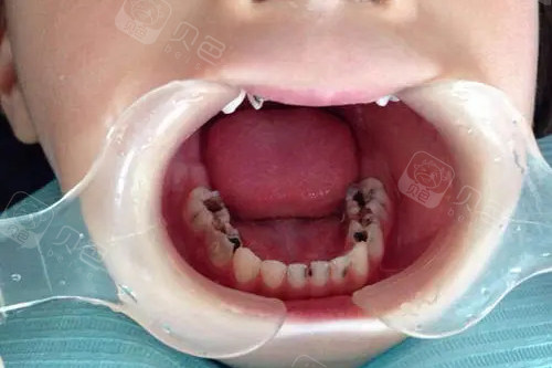 儿童口腔展示图