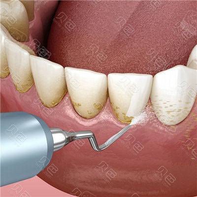 超声波清理牙结石