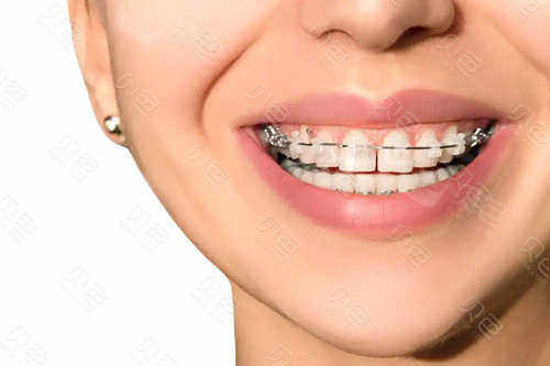 隐形陶瓷托槽牙齿矫正好不陶瓷托槽和金属托槽的区别