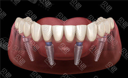 2022年全国种植牙价格表一览表,国产进口种植牙费用明细!