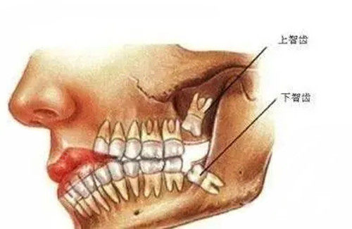 上颌智齿和下颌智齿的位置