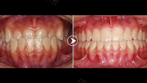 地包天矫正前后