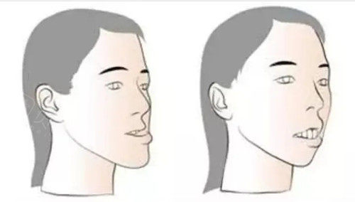 牙齿地包天30岁还能矫正吗30以后矫正地包天有哪些危害