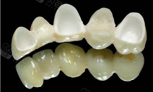 请问重庆全瓷牙1500一颗贵吗便宜的多少钱一颗价格表有吗