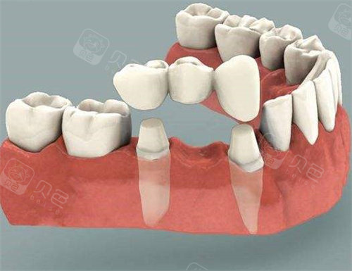 一,连着四颗牙没了可以镶牙