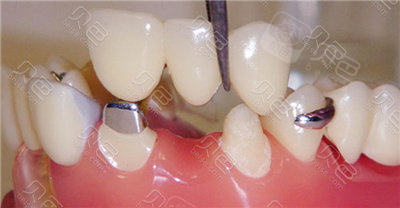 缺失一颗牙齿冠桥