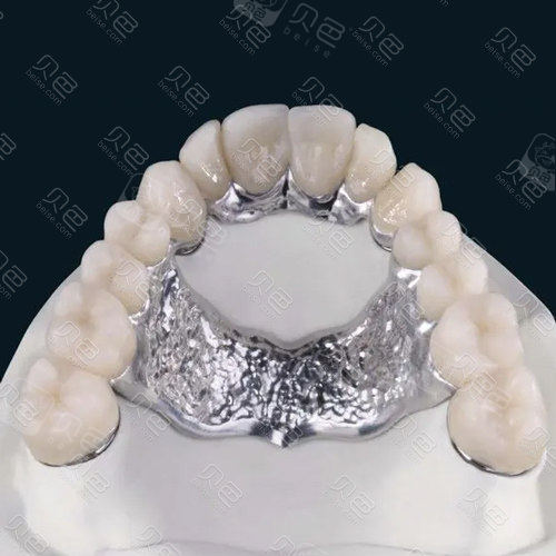 揭秘吸附性义齿用什么基托这种基托有什么优势