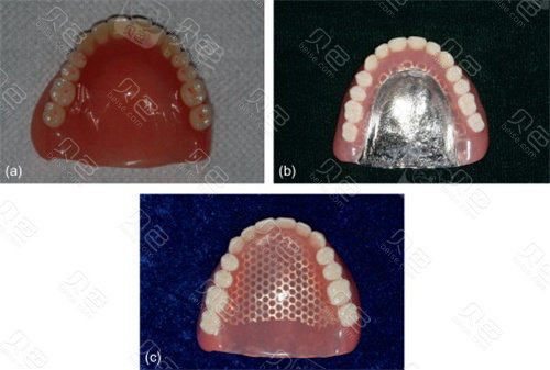 揭秘吸附性义齿用什么基托这种基托有什么优势