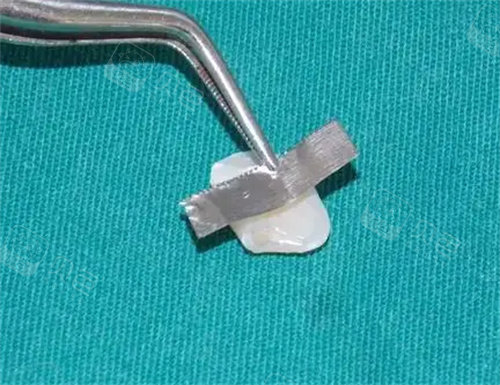 粘结桥示意图修复