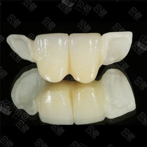 扫盲粘接桥牙齿多少钱一颗能用多久粘结桥牙到底好不好