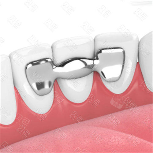 扫盲粘接桥牙齿多少钱一颗能用多久粘结桥牙到底好不好