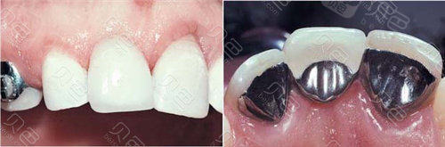 扫盲粘接桥牙齿多少钱一颗能用多久粘结桥牙到底好不好