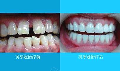 美容冠对比图